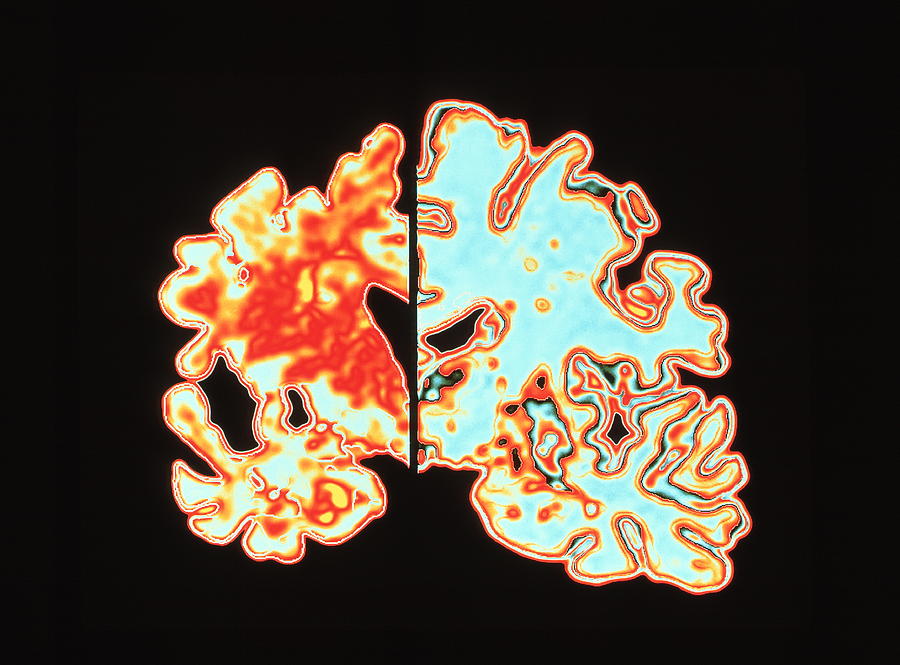 Alzheimers Disease Brain Vs Normal Photograph by Alfred Pasieka/science Photo Library