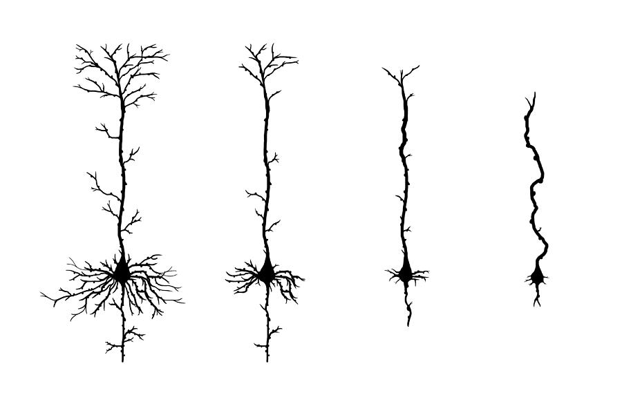 Alzheimers Disease, Neuron Degeneration Photograph by Evan Oto - Fine ...