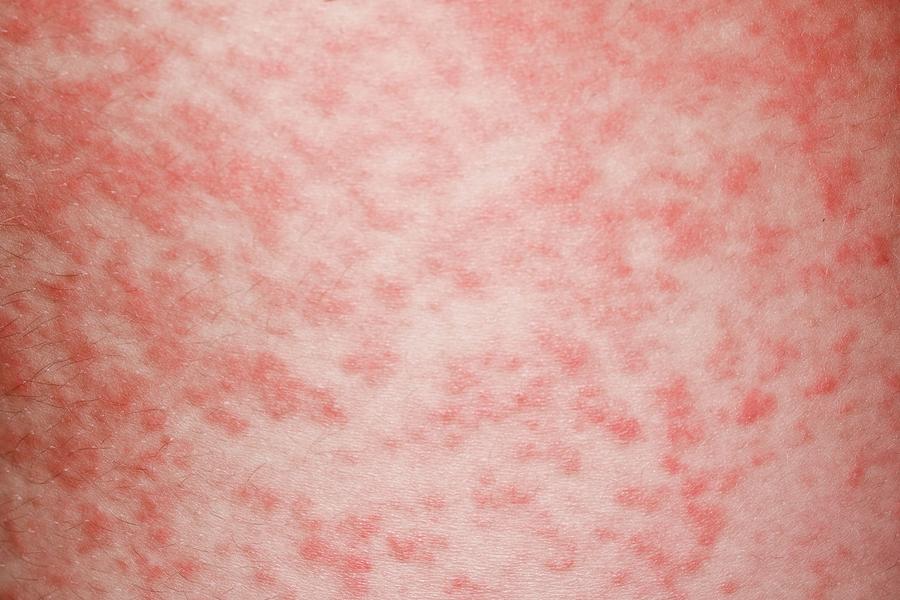 Amoxicillin Rash In Glandular Fever Photograph By Dr P Marazziscience