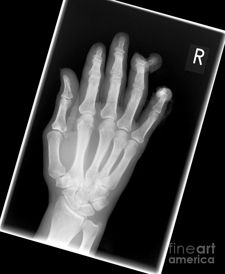 Amputated Fingers, X-ray Photograph by Science Photo Library - Fine Art ...