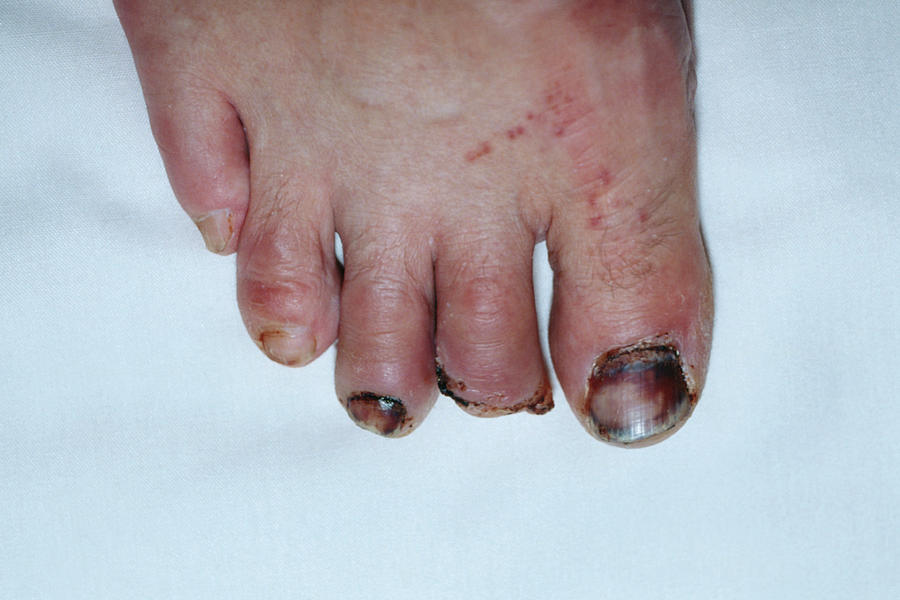 Amputated Toe Photograph by Mike Devlin/science Photo Library