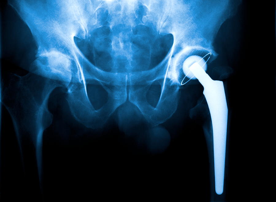 An X Ray of a hip joint problem Photograph by Rike_
