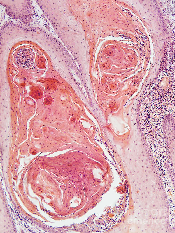Anal Squamous Cell Carcinoma, Lm Photograph by Garry DeLong