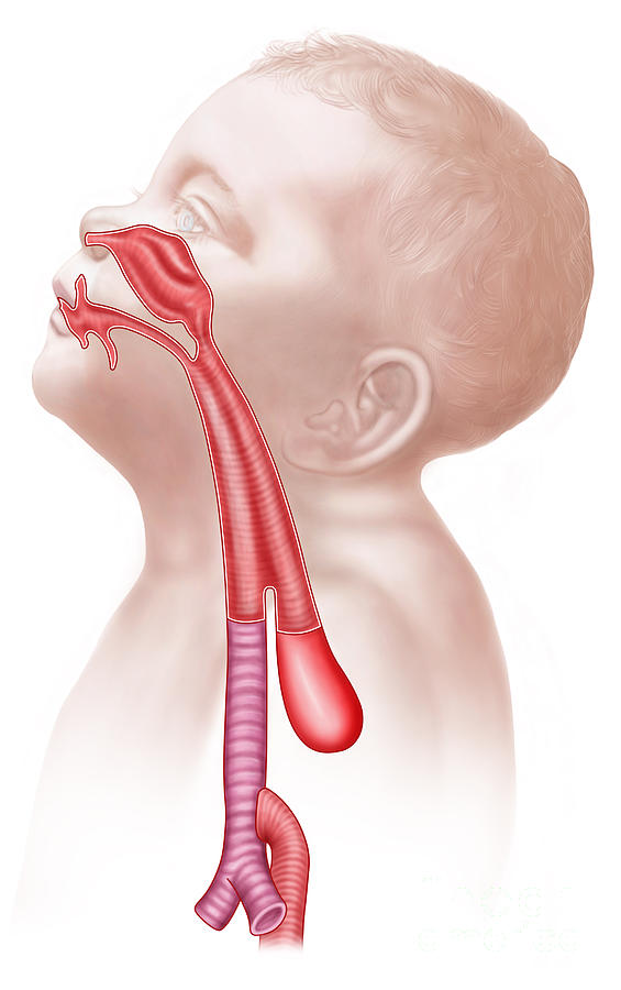 Anatomy Of A Tracheoesophageal Fistula Digital Art by Stocktrek Images