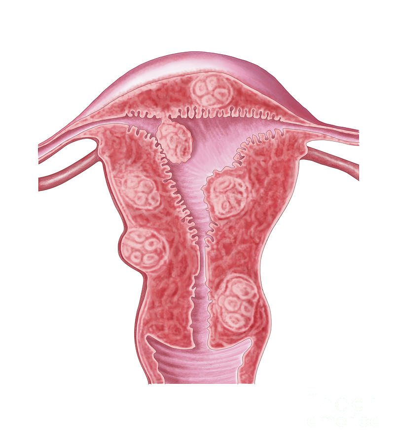 Anatomy Of Fibroid Tumors In Female Digital Art by Stocktrek Images ...