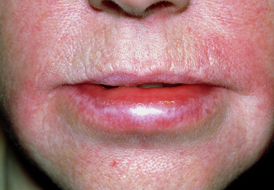 Angioedema Of The Lips Due To An Allergic Reaction Photograph by Dr P ...