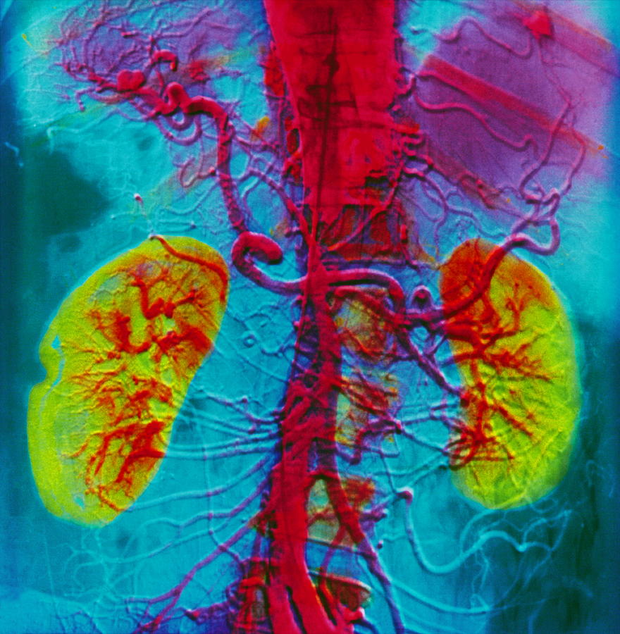 Angiogram Of Kidneys Photograph by Alain Pol, Ism/science Photo Library