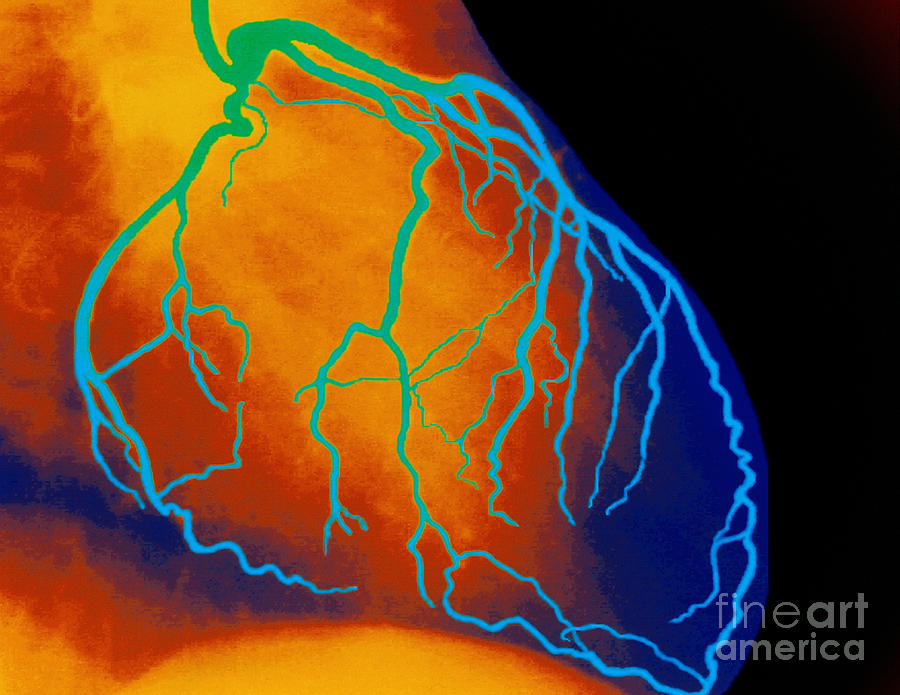 Blood Vessel Photograph - Angiograph Of Heart by Lunagrafix