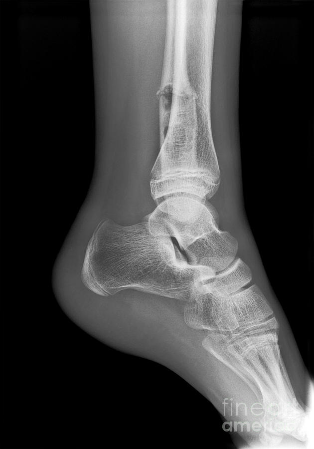 Ankle Fracture With Bone Cyst X Ray Photograph By Science Photo Library My Xxx Hot Girl 1987
