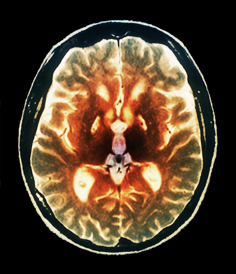 Anoxia Brain Damage By Zephyr/science Photo Library