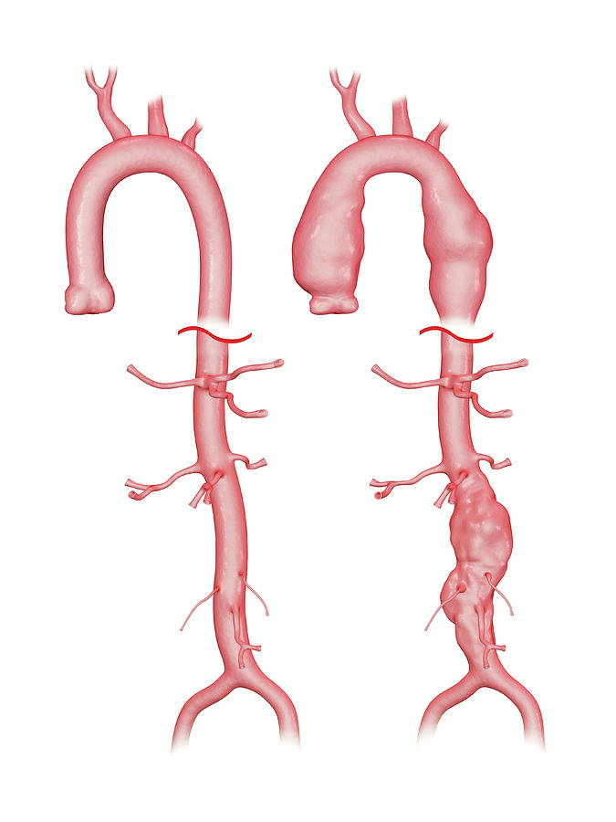 Aortic Aneurysm Photograph by Harvinder Singh