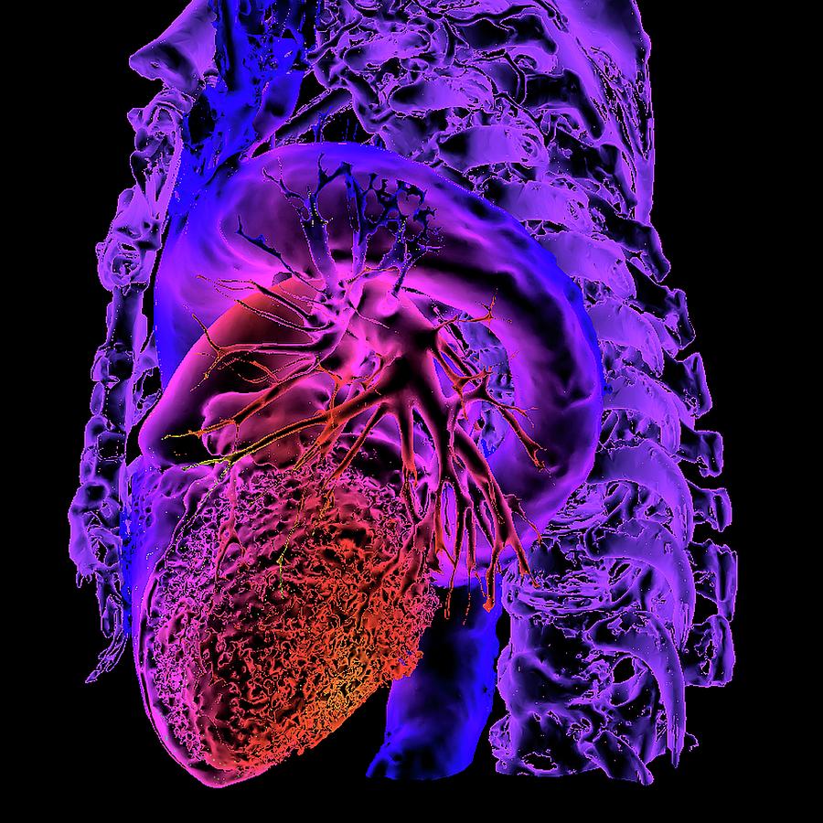 Aortic Aneurysm Photograph by K H Fung/science Photo Library