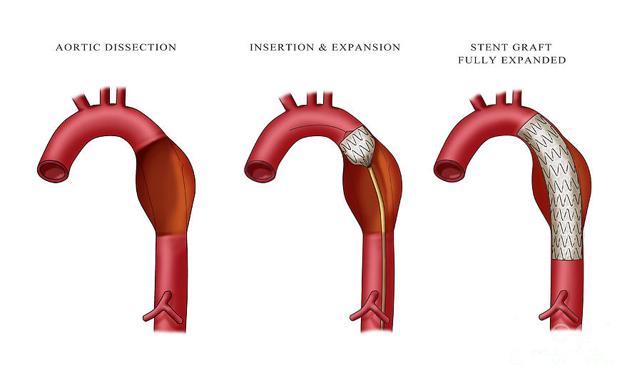 Aortic Aneurysm Stent, Illustration Photograph by Monica Schroeder