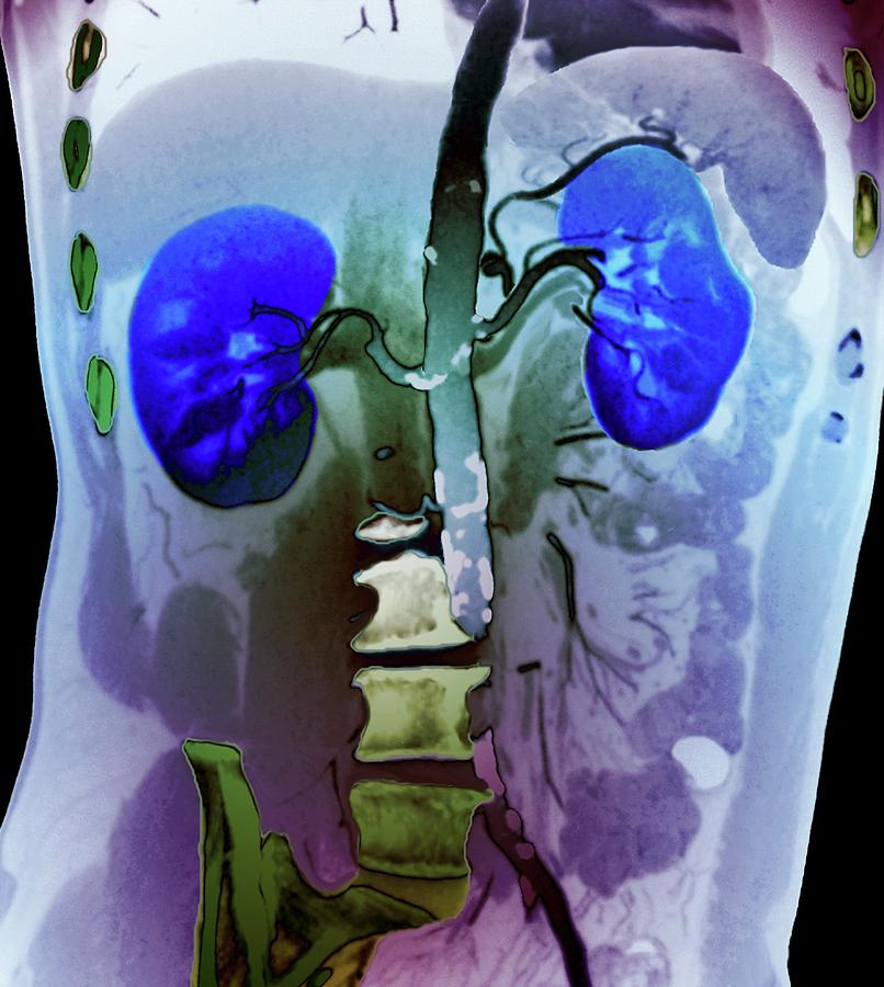 What Is Aortic Atherosclerosis