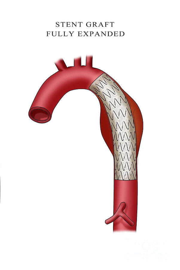 Aortic Stent Graft Illustration Photograph By Monica Schroeder Pixels 1337