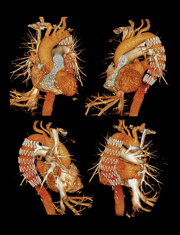 Aortic Stent Graft Photograph By Zephyrscience Photo Library Fine Art America 9828