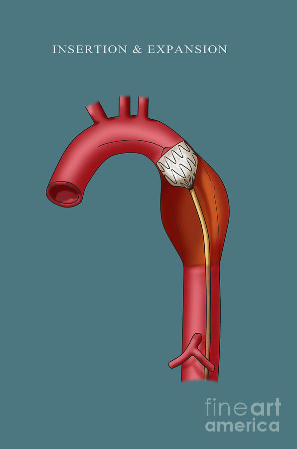 Aortic Stent Insertion, Illustration Photograph by Monica Schroeder