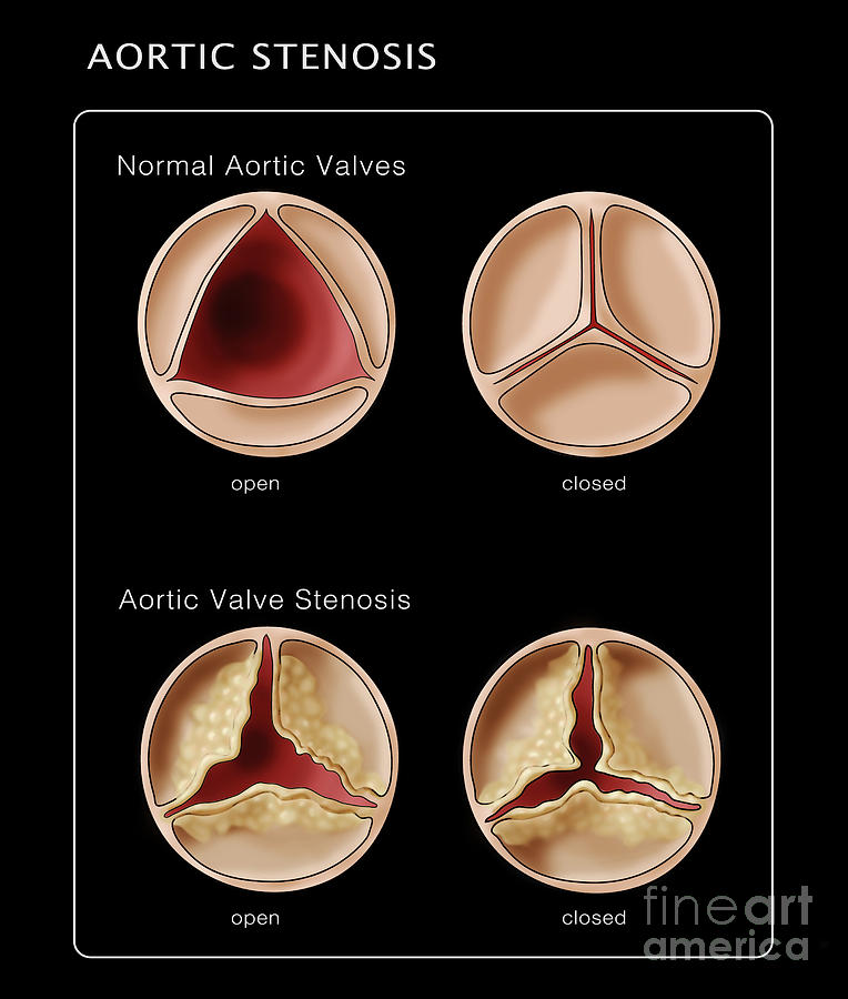 Aortic Valve, Normal & Stenosis Photograph by Monica Schroeder