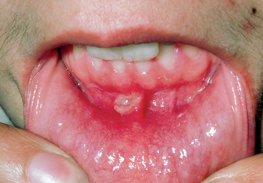 aphthous-ulcer-roof-of-mouth