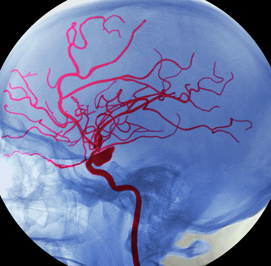 Arterial Aneurysm Photograph by Simon Fraser/rnc, Newcastle/science Photo Library
