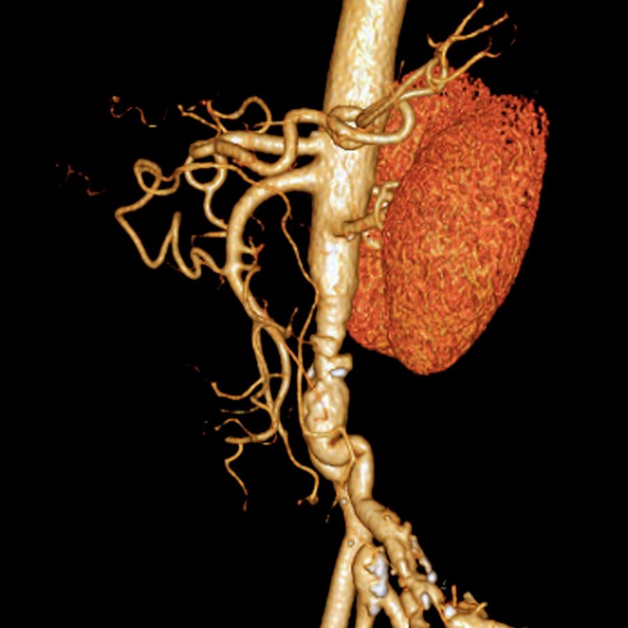 Arterial Bypass Photograph By Zephyr Science Photo Library 