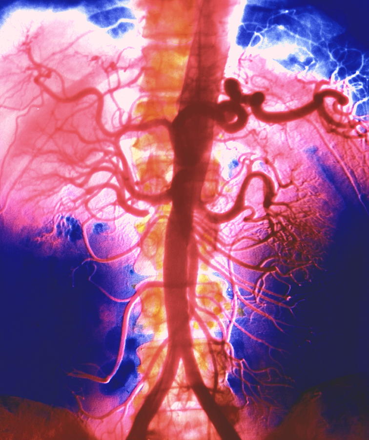 Arteriogram Of Abdominal Arteries Photograph by Alain Pol, Ism/science Photo Library