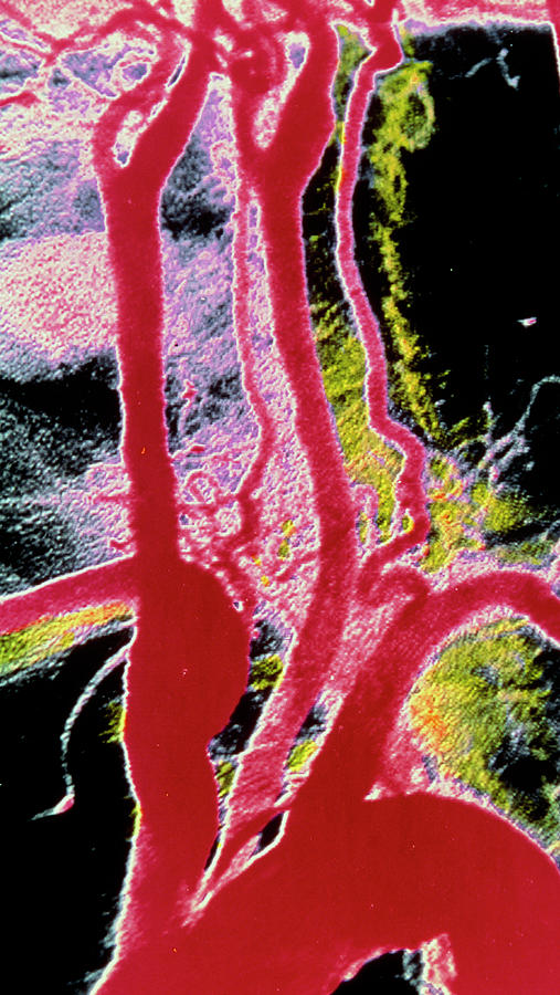 Arteriograph Of Aortic Arch & Associated Arteries Photograph by Alain Pol, Ism/science Photo Library