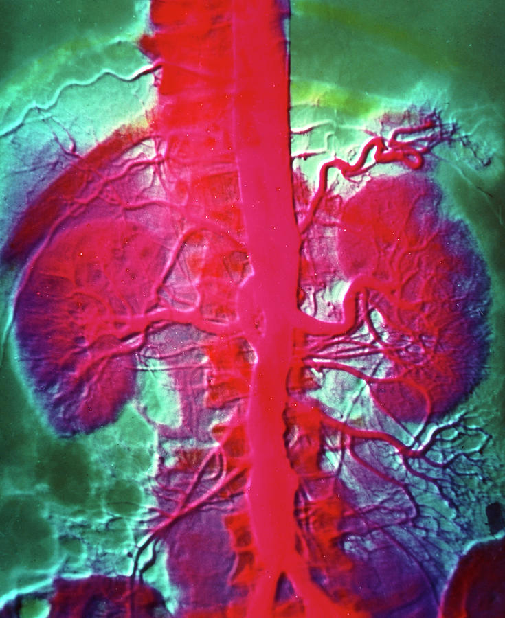 Arteriograph Showing Blood Supply To The Kidneys Photograph by Alain Pol, Ism/science Photo Library