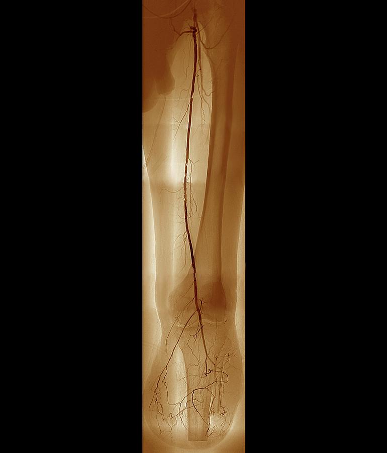 Arteritis Of The Leg Photograph by Zephyr/science Photo Library