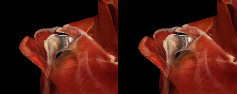 Arthritic And Nonarthritic Shoulder Photograph by Anatomical Travelogue