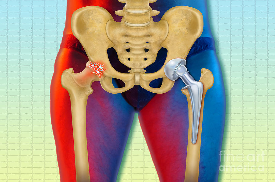 Arthritic And Replacement Hip Photograph by Chris Bjornberg