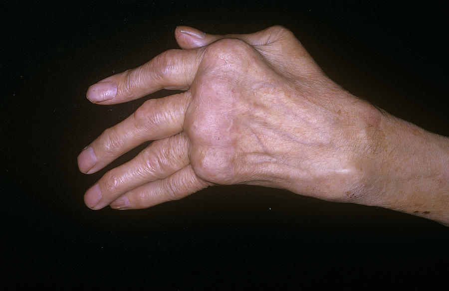 Arthritic Hand Photograph by Mike Devlin/science Photo Library Pixels