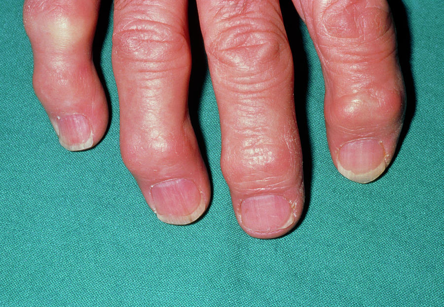 arthritic-hand-showing-heberden-s-nodes-on-fingers-photograph-by-dr-p