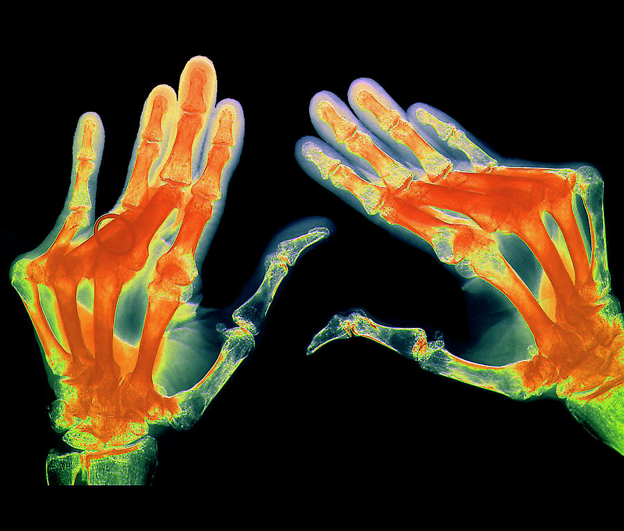Arthritic Hands Photograph by Zephyr/science Photo Library
