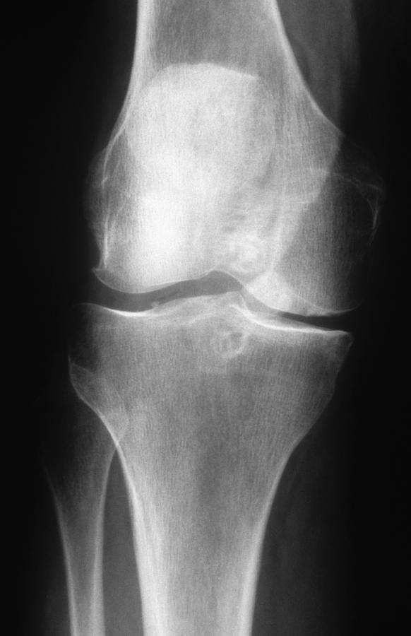 Arthritic Knee, X-ray Photograph by Chris Bjornberg