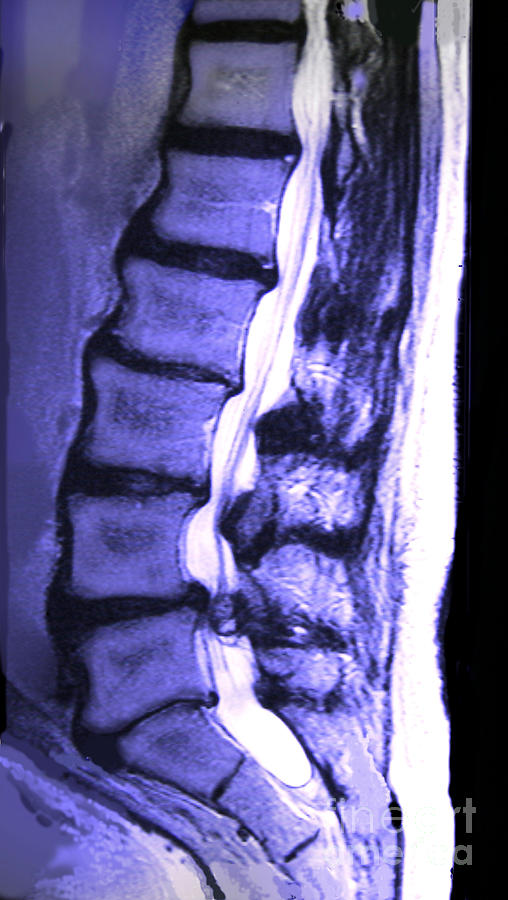 Arthritic Spine Photograph by Chris Bjornberg