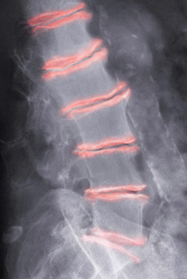 Arthritis Of The Back Photograph by Cnri/science Photo Library