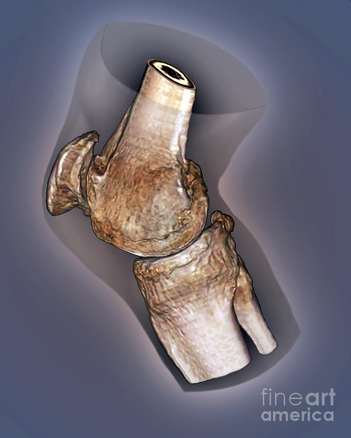 Arthritis Of The Knee 3d Ct Scan Photograph By Zephyr 1414