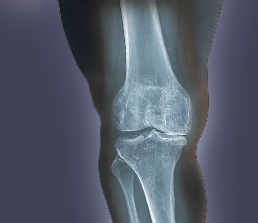 Arthritis of the knee, X-ray Photograph by Science Photo Library - ZEPHYR