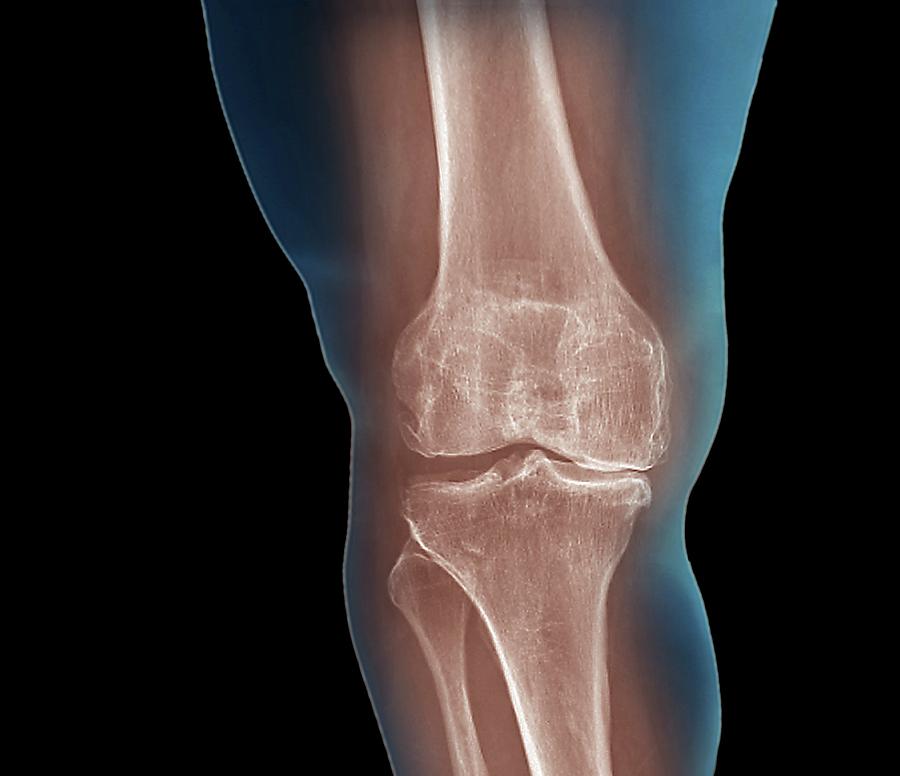 Xray Photograph - Arthritis Of The Knee by Zephyr/science Photo Library