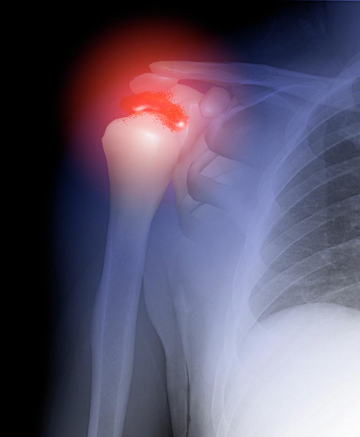 Arthritis Of The Shoulder Photograph by Gunilla Elam/science Photo ...