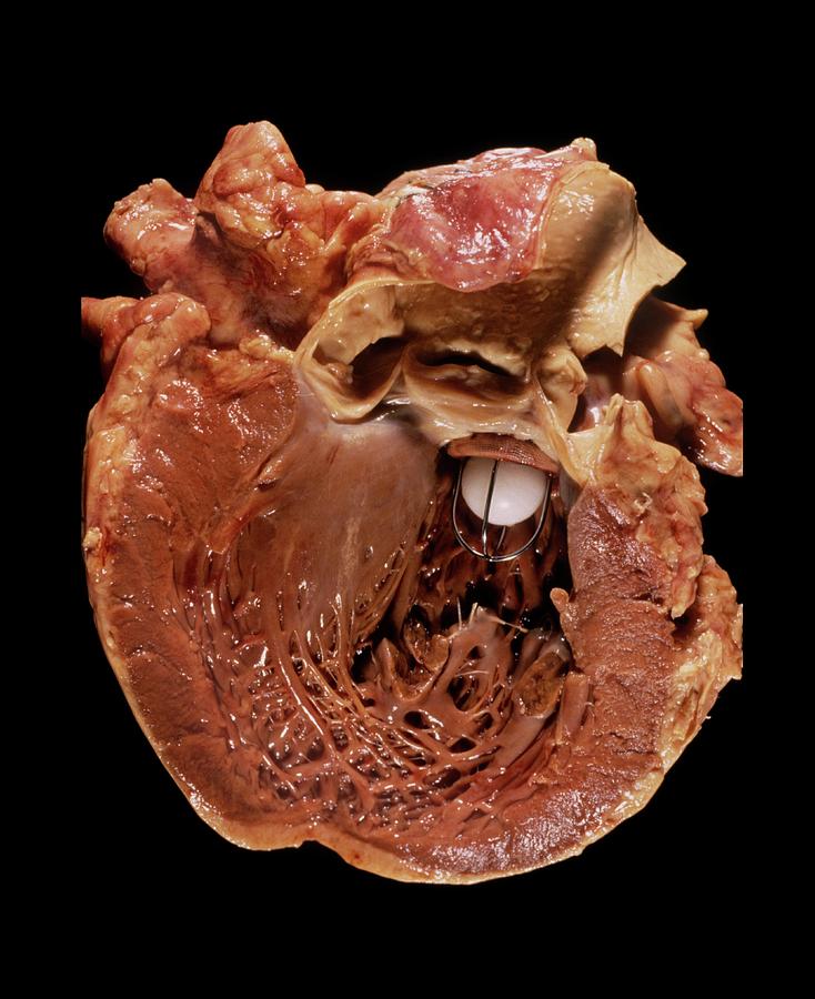 Artificial Heart Valve Photograph by Pr. M. Forest - Cnri
