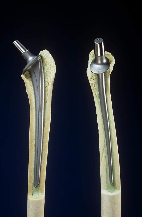 Artificial Hip Joints Photograph by Mike Devlin/science Photo Library