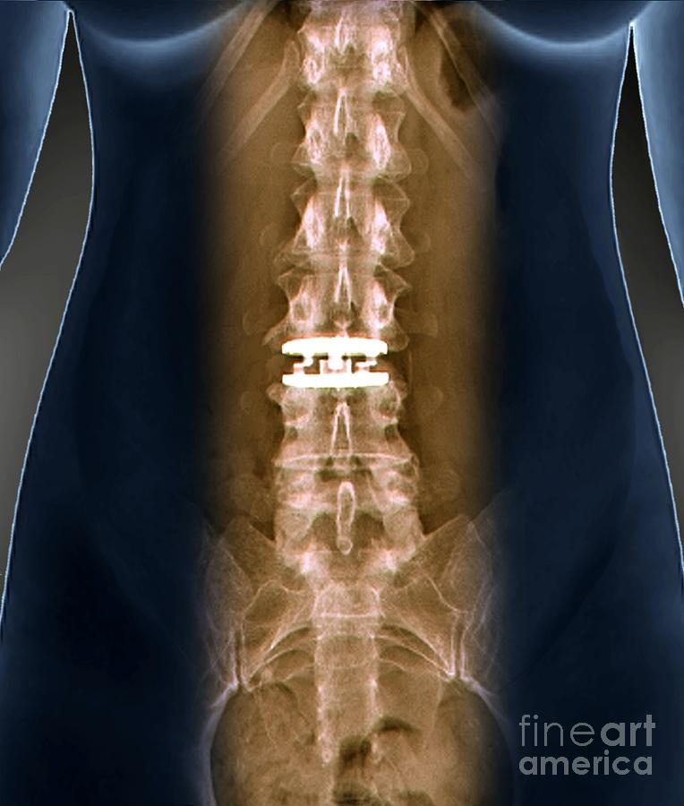 Best disc replacement surgeons image