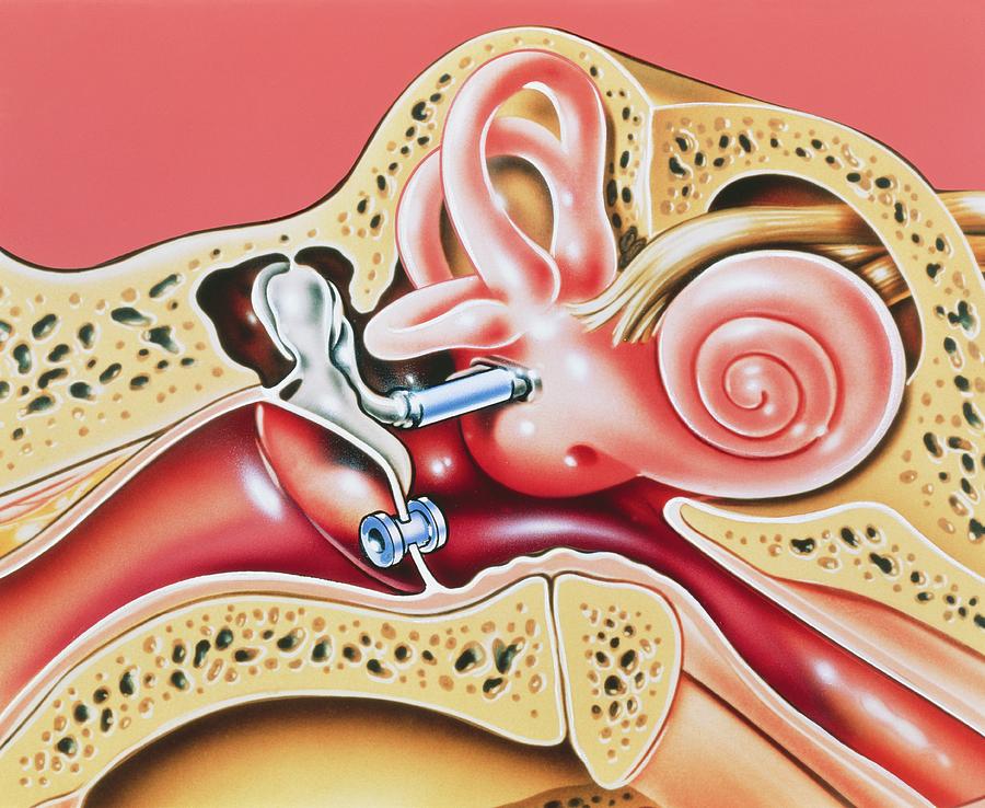 Artwork Of Prosthetic Stapes In Middle Ear Photograph by John