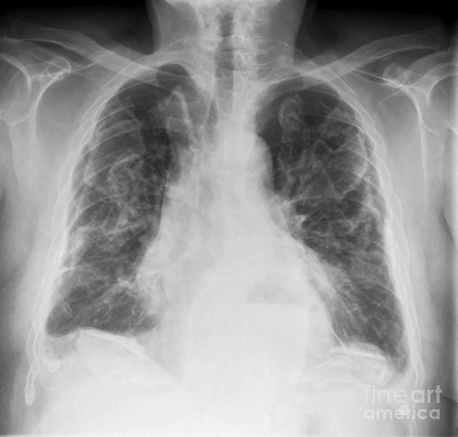 Asbestosis, X-ray Photograph by Science Photo Library