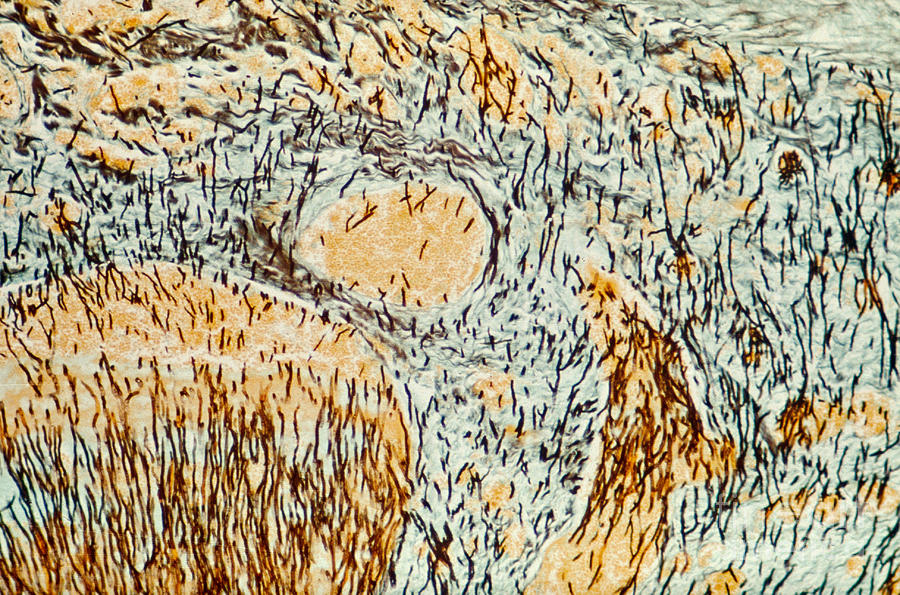 Micrograph Photograph - Aspergillus Pneumonia Micrograph by Biophoto Associates
