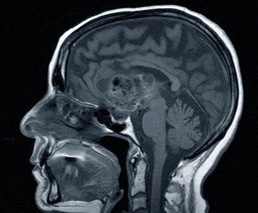 Astrocytoma Brain Cancer by Zephyr/science Photo Library