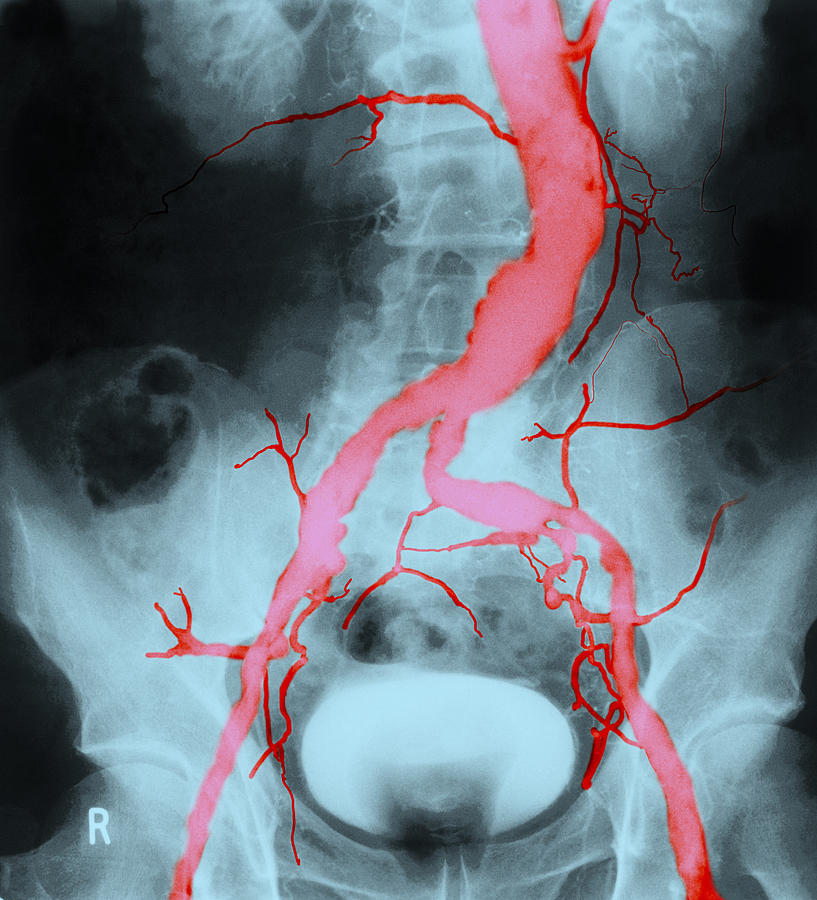 Atheroma In Aorta And Iliac Arteries Photograph by John Watney