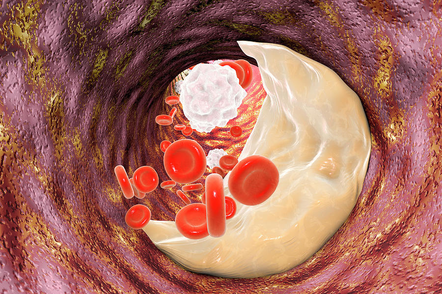 Atheromatous Plaque Photograph by Kateryna Kon/science Photo Library